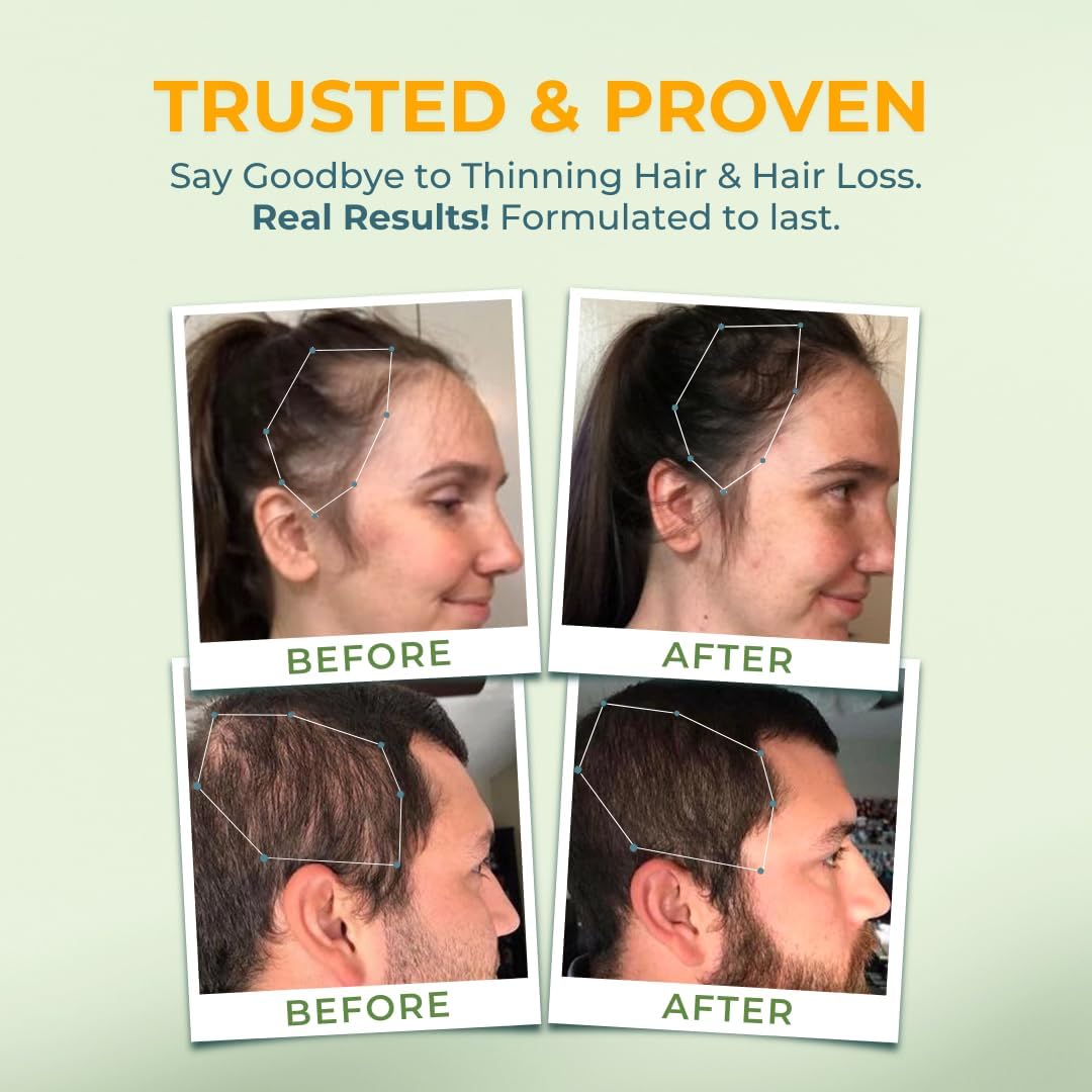 Vital Hair Complex -Hair Growth Vitamins for Women and Men -Biotin & Vitamin B -Hair Growth Supplement for Healthy Hair Skin & Nails -Hormone & Gluten Free -Hair Vitamins for Women - Medaid