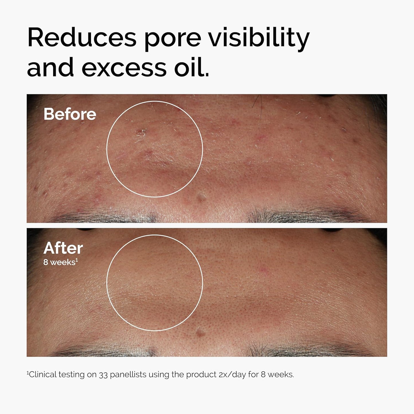 The Ordinary Niacinamide 10% + Zinc 1%, Smoothing Serum for Blemish-Prone Skin - 30ml - Medaid