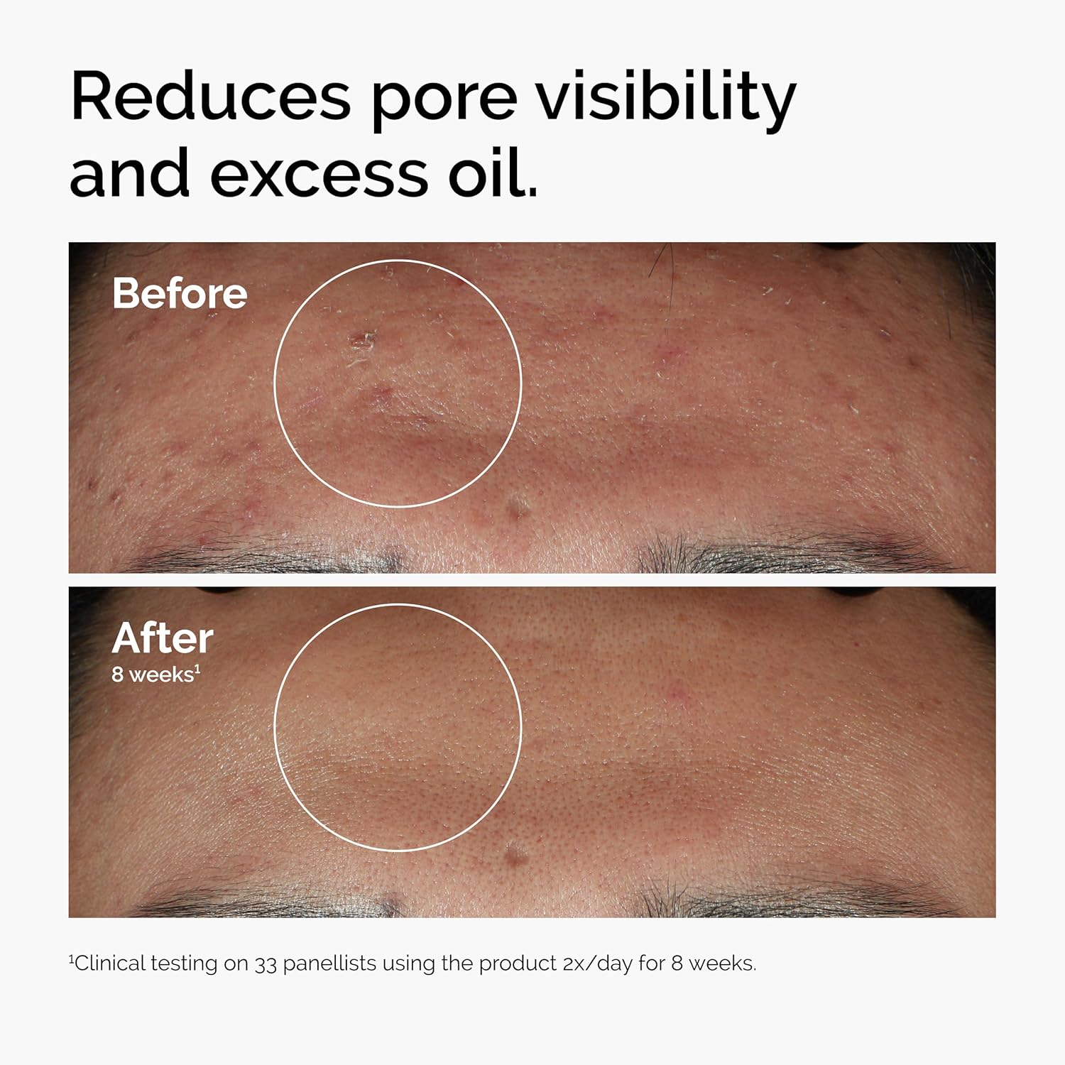 The Ordinary Niacinamide 10% + Zinc 1%, Smoothing Serum for Blemish-Prone Skin - 30ml - Medaid